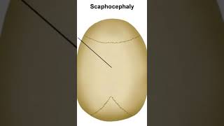 Scaphocephaly