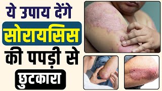 Psoriasis gharguti upchar | Summer Home Remedy For Psoriasis Patient