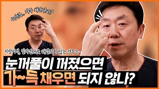 꺼진 눈꺼풀, 무작정 채우기만 해서는 안됩니다. 눈꺼짐에 대처하는 올바른 수술법! | 쌍수, 눈썹하거상, 눈위지방재배치 - 의학박사 백승준