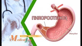 Пилоростеноз после язвы. Какие симптомы? Как лечить?