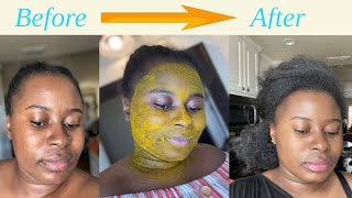 I Tried Turmeric Face Mask For 4 Days || ACNE AND DARK MARKS FAST / TheSophieShow