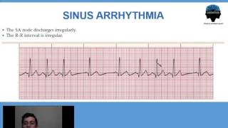 4  Arritmia Sinusal Respiratoria