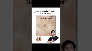 Scarless Gynecomastia is the Future of Gynecomastia Correction (+919795800800) #gynecomastia