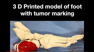 Foot or Calcaneus bone tumor surgery :Chondrosarcoma Bone Cancer Surgery with 3D Printed Bone model