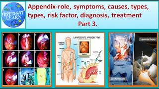 Appendix role, Symptoms, causes, types, Risk factor, diagnosis, treatment Part 3