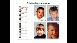 Cri-du-chat-syndrome