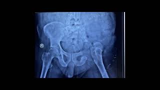 Pelvis Bone Tumor or Hemipelvectomy Patient's : Walking Video