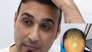 Hair transplant Experience