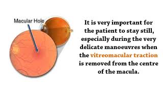 Vitreomacular Traction Surgery By Mahi Muqit