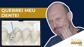 QUEBREI MEU DENTE E USEI A ODONTOLOGIA DIGITAL PARA RESTAURAR! ALINHAMENTO E PLANEJAMENTO 3D