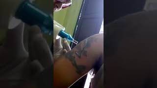 LASER TATTO - HAPUS TATTO PERMANEN