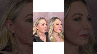 62 Year Old Looks 20 Years Younger After Facelift! 🤯