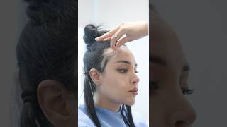 FOREHEAD REDUCTION BY HAIR TRANSPLANT AFTER 10 DAYS | HAIR TRANSPLANT RESULT