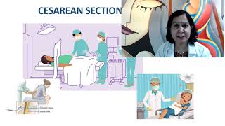 Mode of Delivery – Normal Vs C-Section – Dr Rita Singh