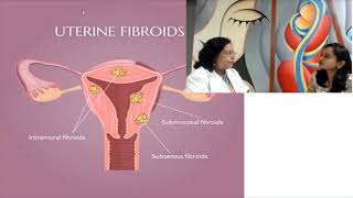 Fibroids - Definition, Symptoms, Causes, Treatment - Dr Rita Singh