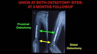 Radiotherapy in Bone tumor surgery : Shoulder or Arm bone tumor surgery