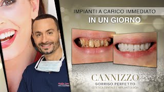 Impianti a Carico Immediato In Un Giorno - Dr. Cannizzo