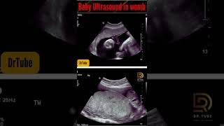 baby ultrasound in monther womb | ultrasound of the fetus #pregnancy #ultrasound #womb