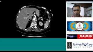 CT Scan Study of Aortic Dissection by Dr. Arjun Kalyanpur