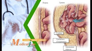 Грыжа передней брюшной стенки. Какие причины? Какие симптомы? Как лечить?