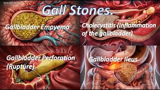 Gallstones  Complications, DiagnosisTests, Imaging tests