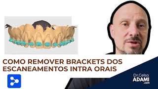 Como Remover Brackets de Escaneamentos Intraorais no Medit Link