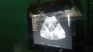 Ultrasound ng aking Sebby ❤️❤️