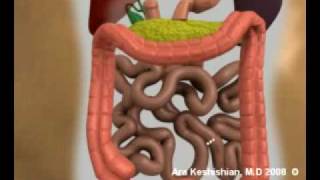 Duodenal Switch operation