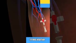 #medicalanimation #ivcannulation #cannula #mbbsmotivation #mbbslove #motivationalvideo #shortsvideo