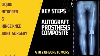 Femur Autograft Bench Operation:Tumor Resection & Liquid Nitrogen treated Bone Prosthesis Composite