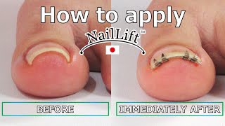 How to apply "NailLift" an ingrown toenail corrector / English v5