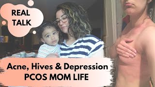 What Happened After I Stopped Breastfeeding | ACNE, HIVES & DEPRESSION