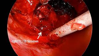 Spinal Epidural Capillary Hemangioma with Intrathoracic Extension