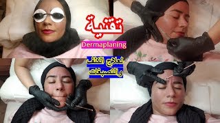 أخيرا زعمت ودرت تقنية dermaplaning لعلاج الكلف و التصبغات(اكتشفوا النتيجة)