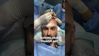 HAIR TRANSPLANT AFTER 6 MONTHS | HAIR TRANSPLANT RESULT