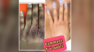 Quel produit j’ai utilisé pour soigner mes brûlures de dépigmentation ratée