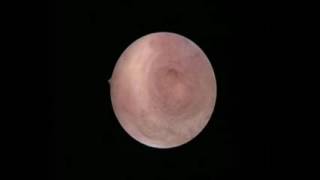 hysteroscopy