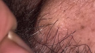 ASMR hair zoning beard removal sonda | ingrown 10 ingrown