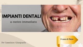 Implantologia dentale - denti fissi