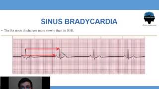 2  Bradicardia Sinusal