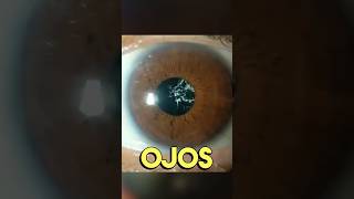 Ojos con HIALOSIS ASTEROIDE 👁️