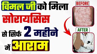 सोरायसिस हुआ 2 महीने में ठीक | Psoriasis treatment | how to cure psoriasis permanently | skin care