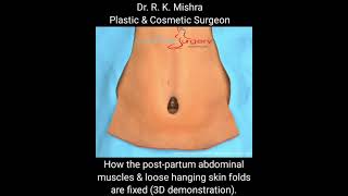 How post-pregnancy Belly fat, loose hanging lower tummy skin, muscles & stretch marks are Fixed