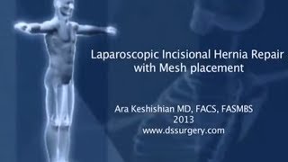 Laparoscopic Incisional Hernia Repair with Mesh Placement