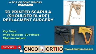 Use of 3 D Printed Scapula Implant in Surgical Management of Ewings Sarcoma of Scapula