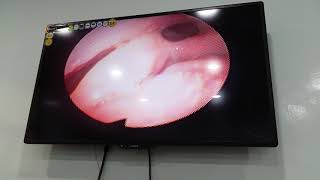 Passing ETT through endoscope