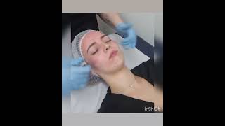 How Is Microneedling Different To Microblading?