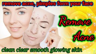 remove pimples | remove acne | clean dark sports|  make your skin even tone| smooth skin|white skin