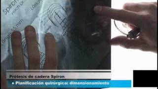 Chirurgie: Spiron OP Mexico - Part I -