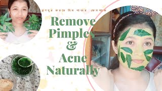 How to Remove  Pimple/Acne Naturally | ব্রণ দূর করো মাত্র ৩ দিনে । Neem Face Pack to get 100% Result